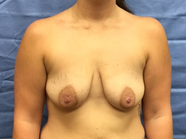Anterior Before