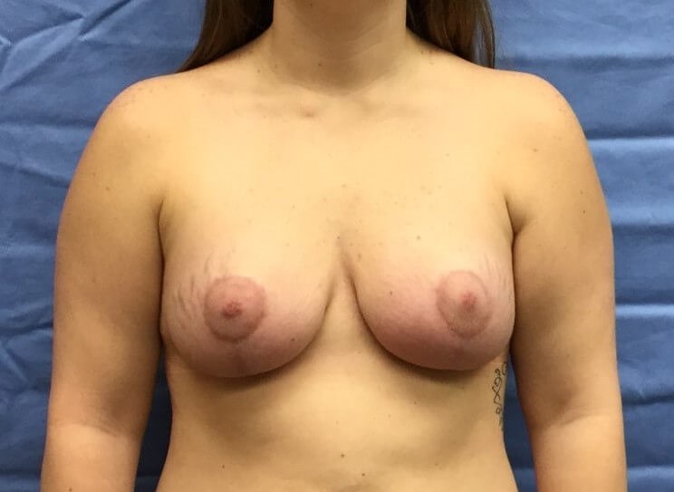 Anterior After