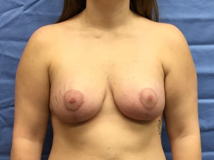 Anterior After