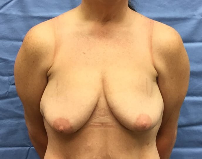 Anterior Before