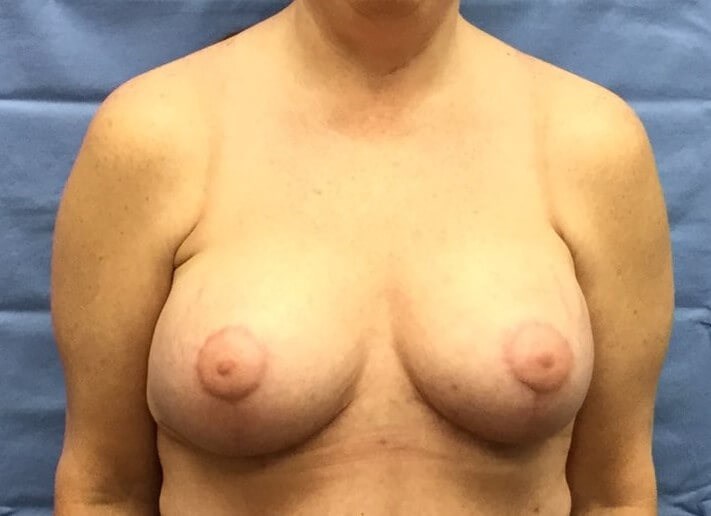 Anterior After