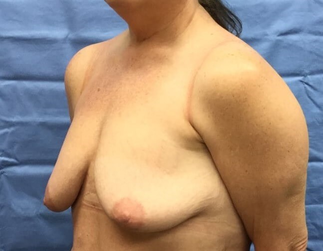 Oblique Before