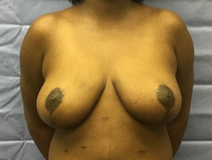 Anterior After