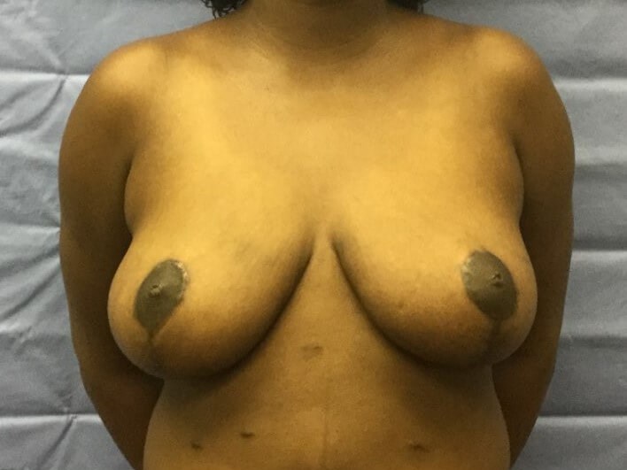 Anterior After