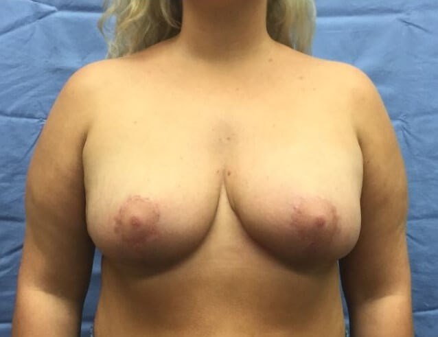 Anterior After