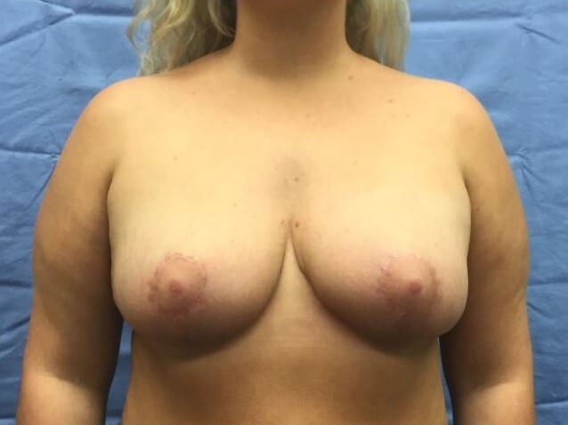 Anterior After