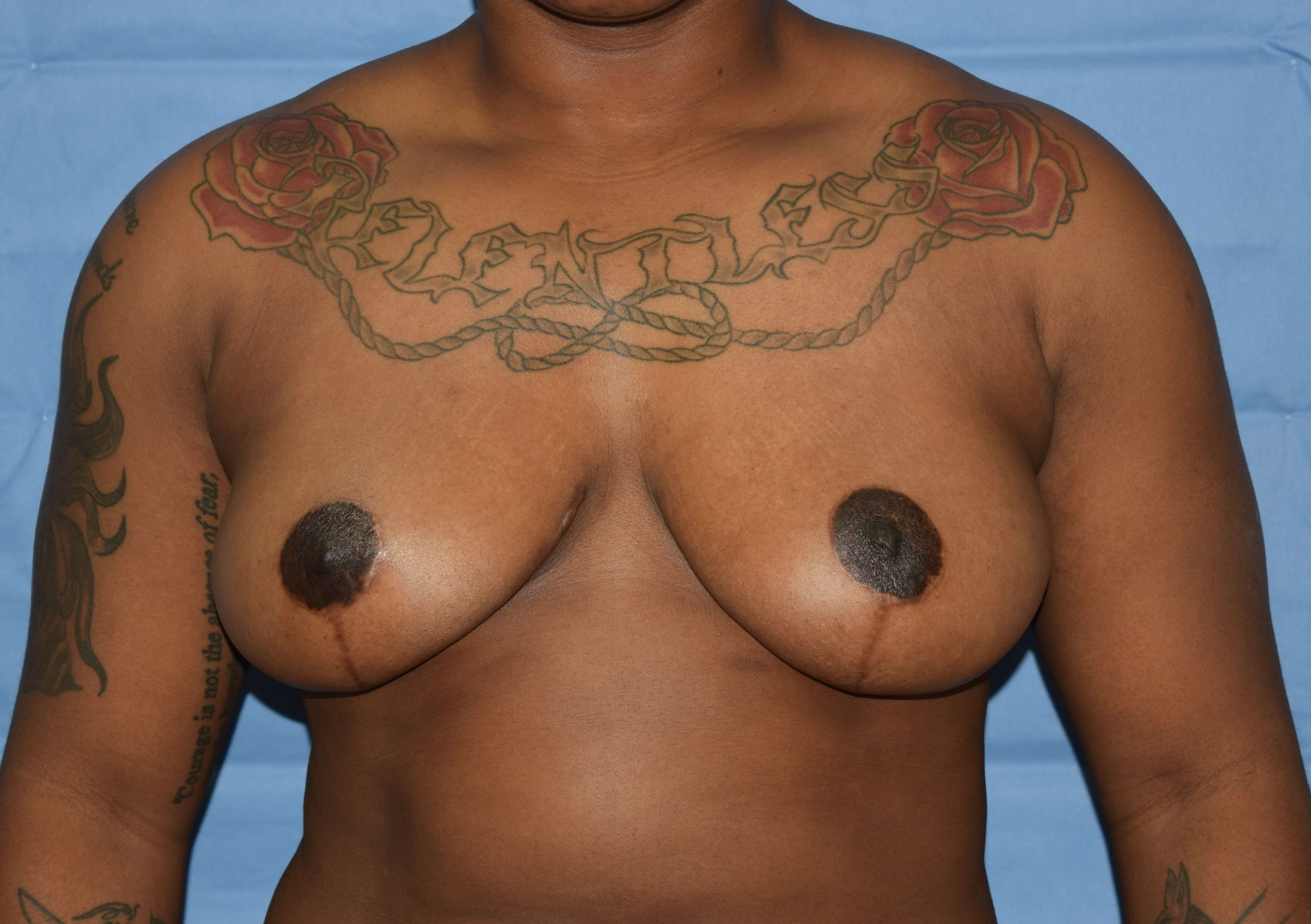 Anterior After