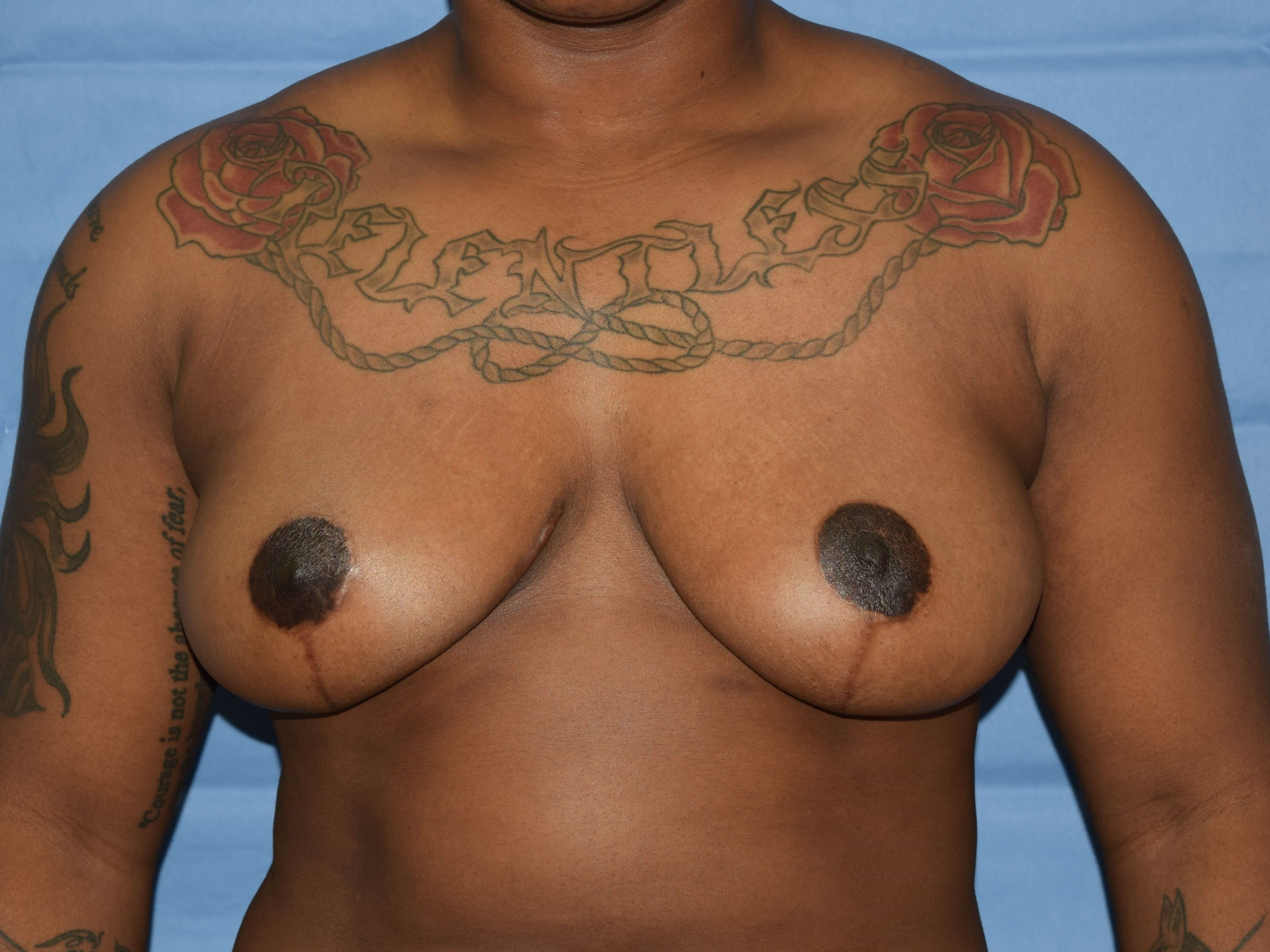 Anterior After