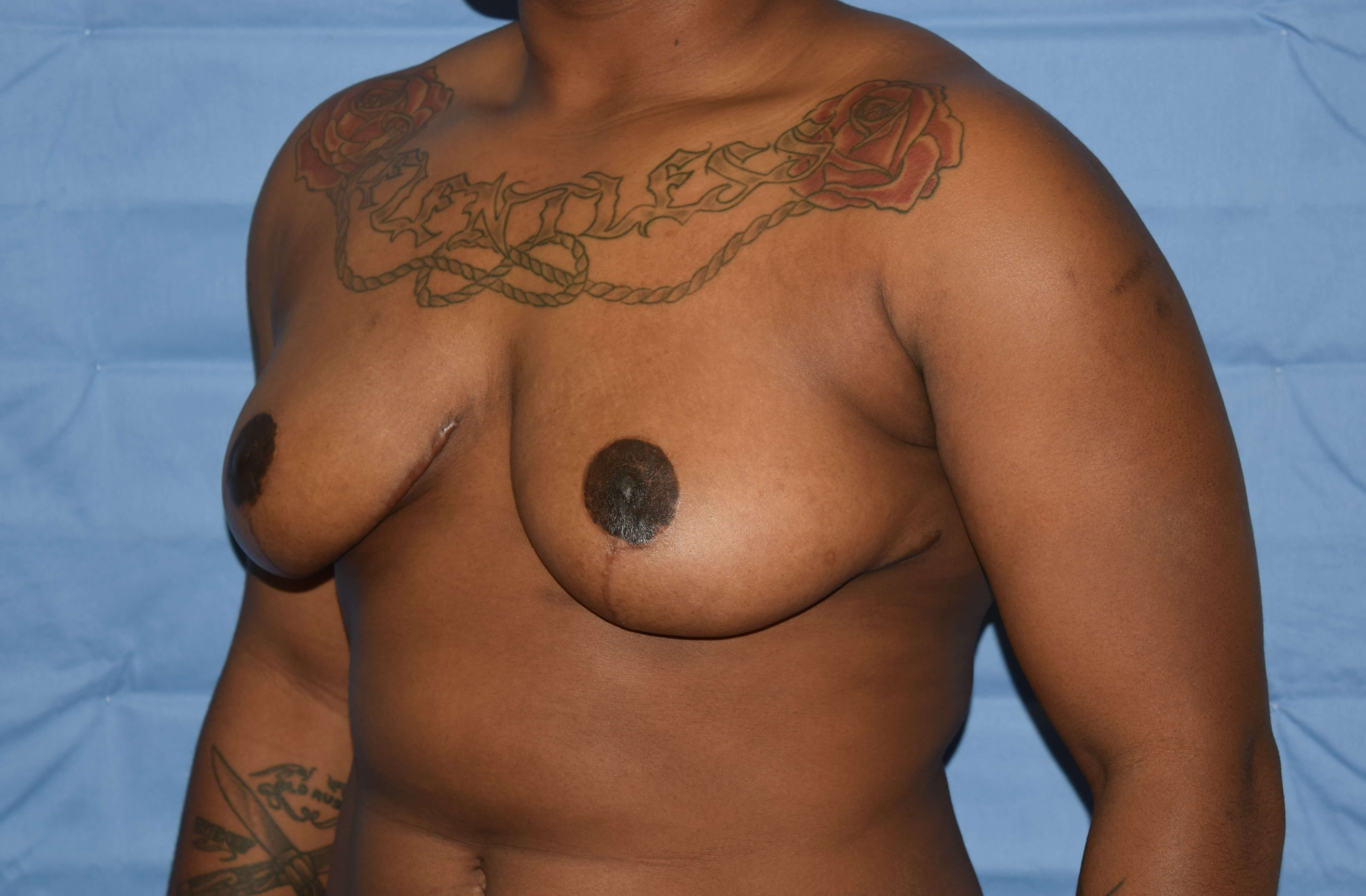 Oblique After