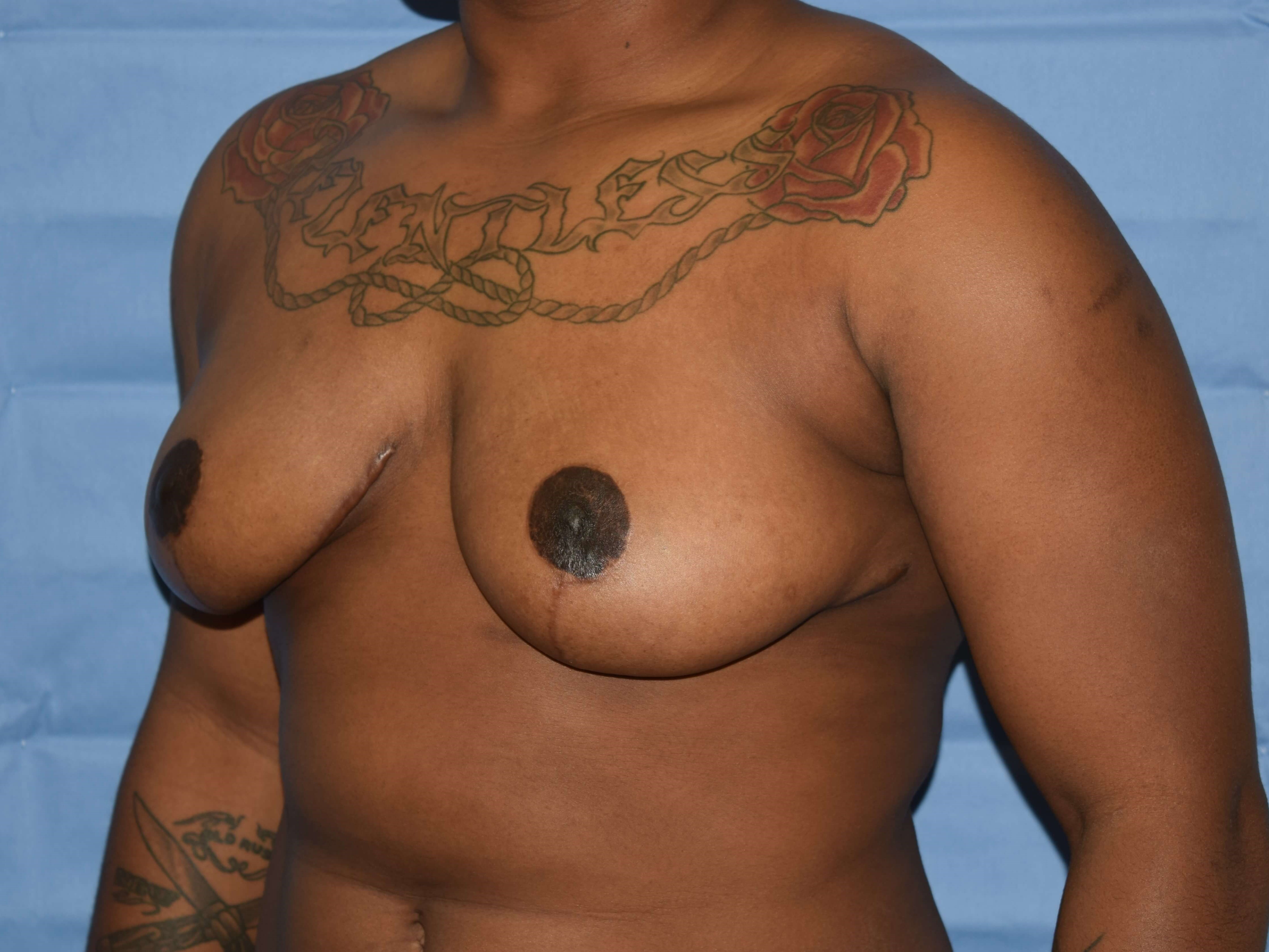 Oblique After