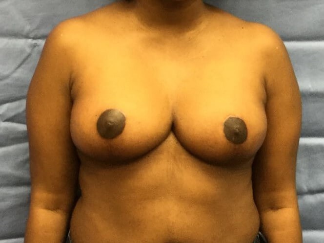 Anterior After