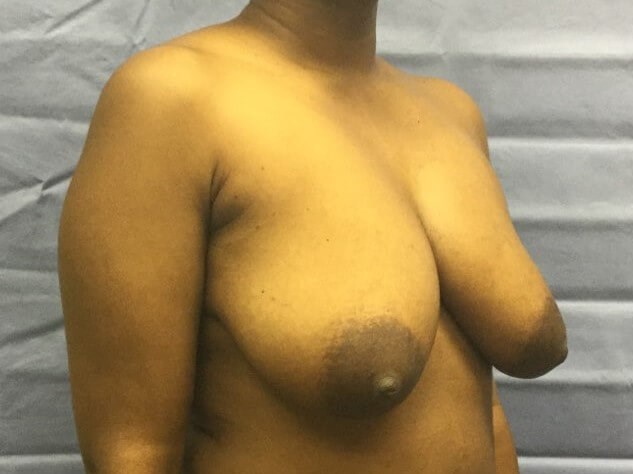 Oblique Before