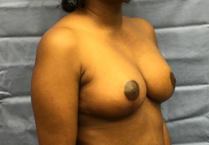 Oblique After