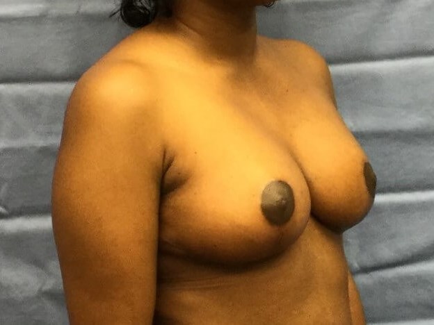 Oblique After
