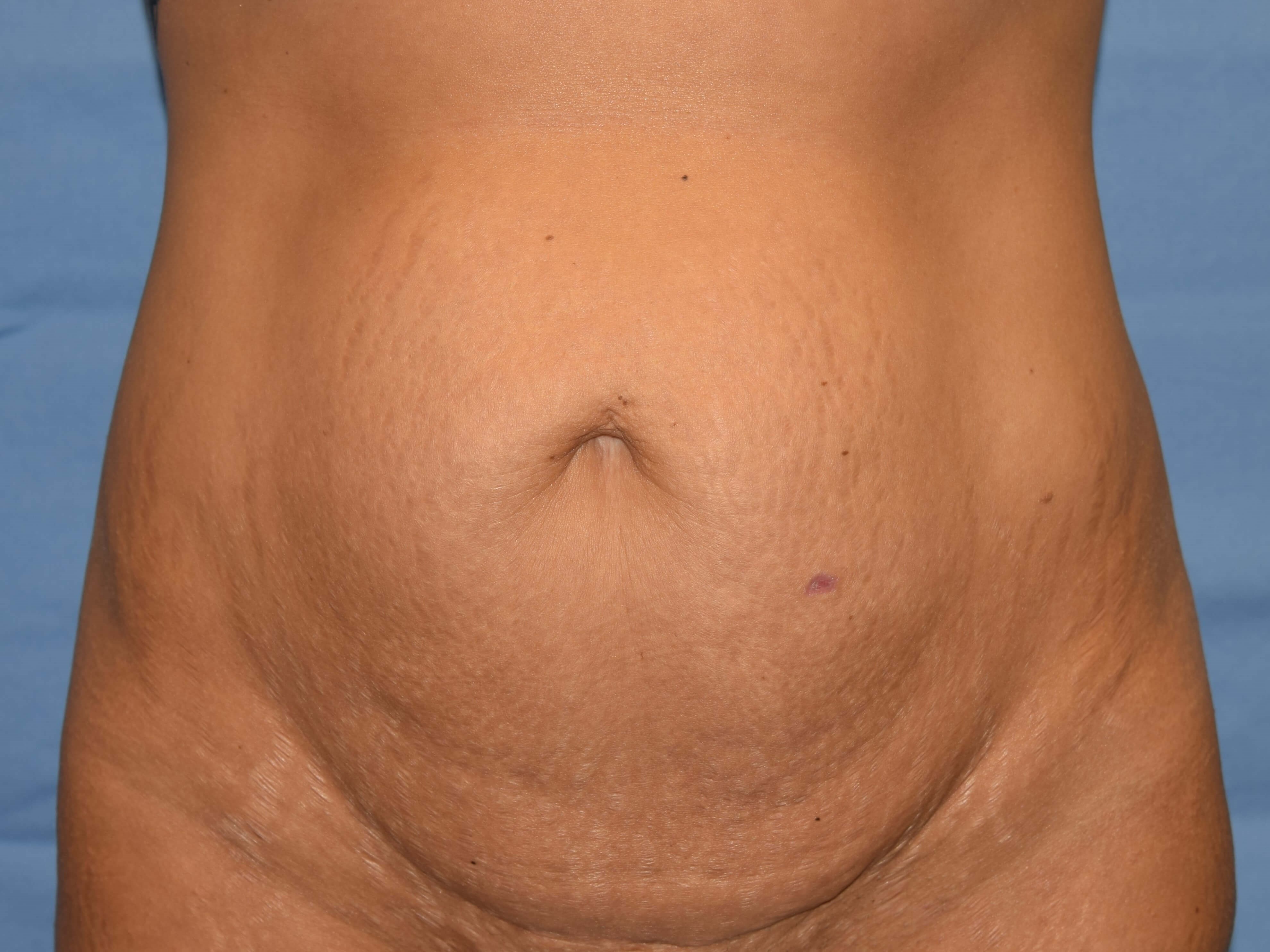 Anterior Before