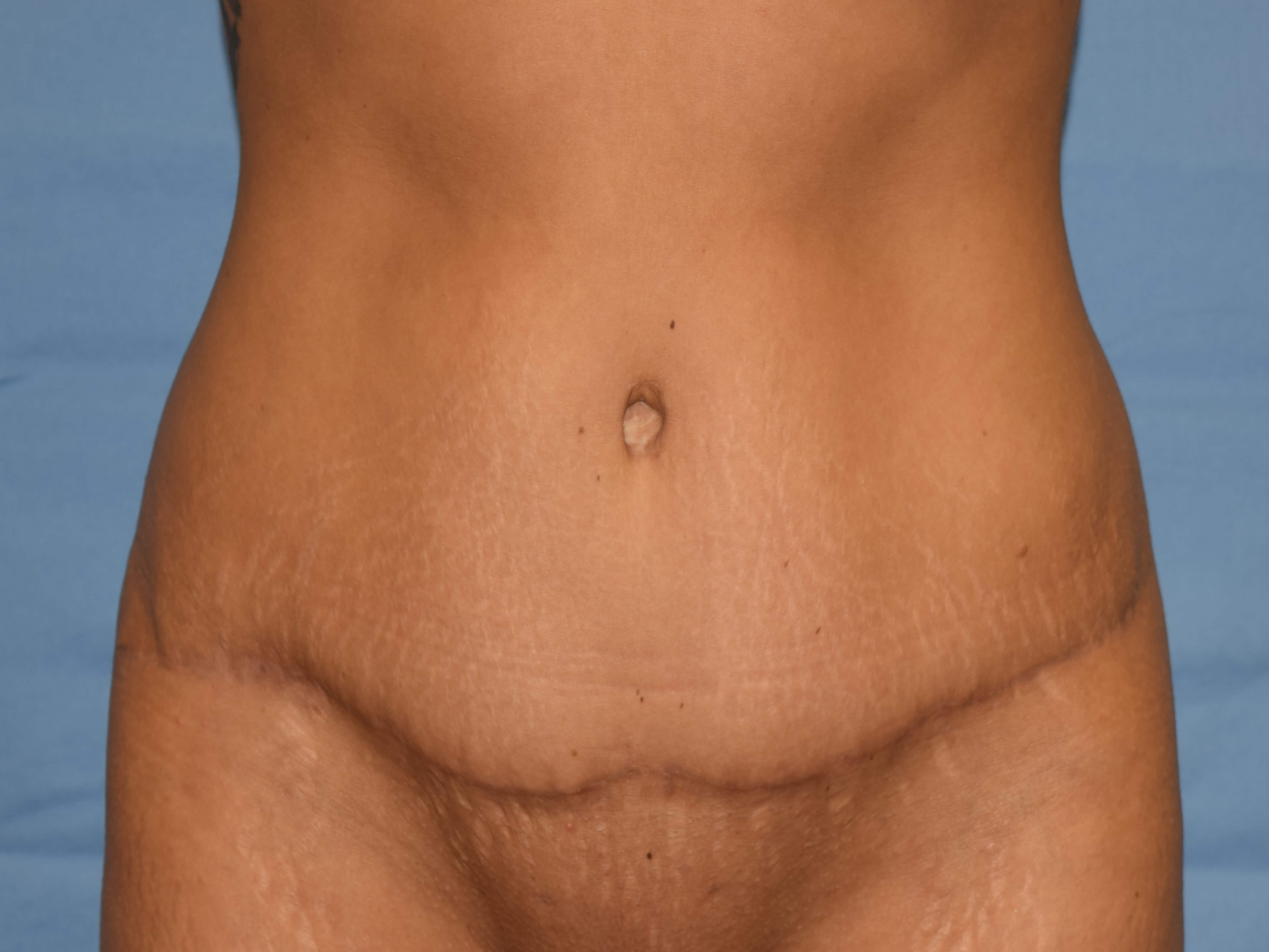 Anterior After
