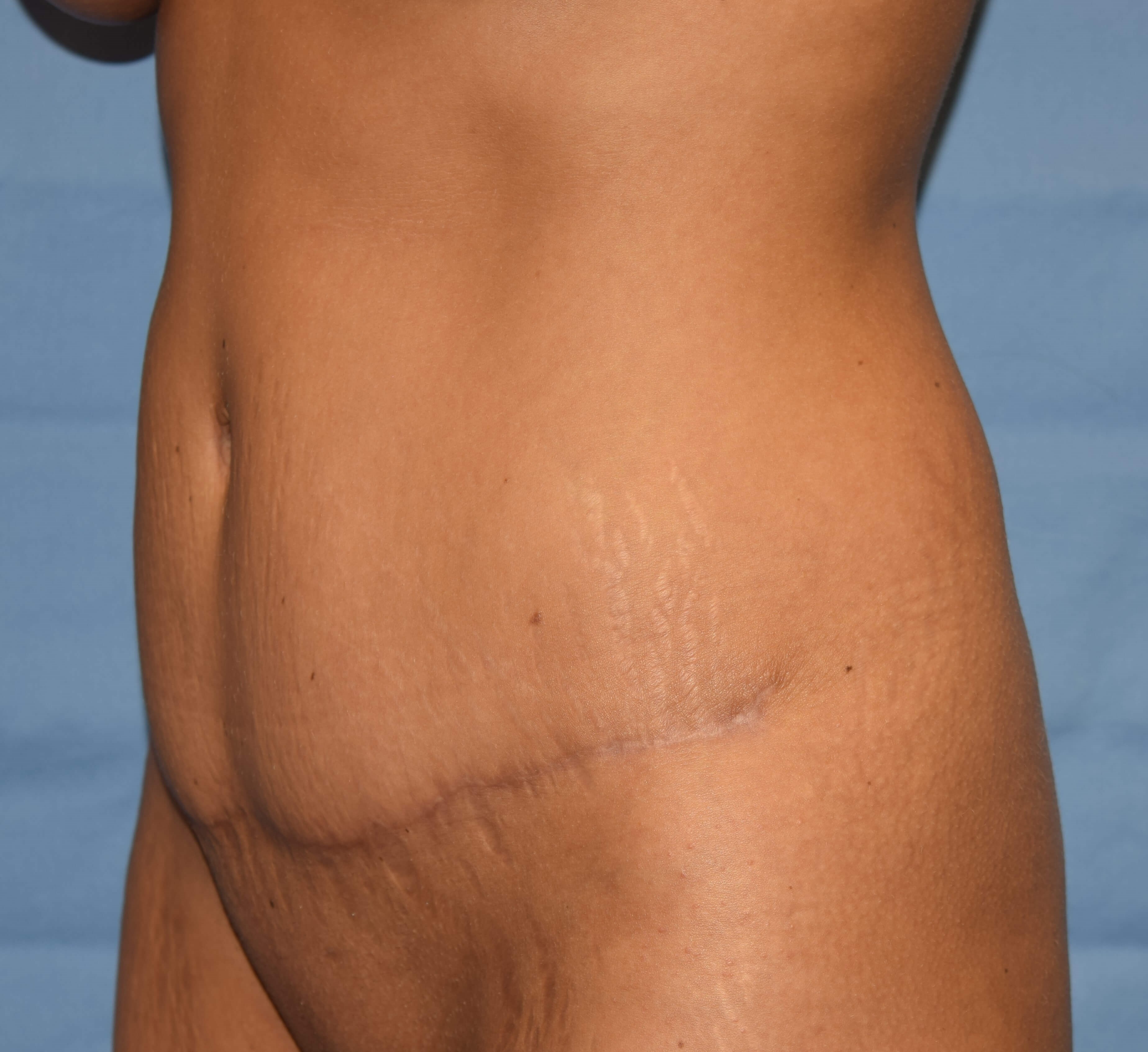 Oblique After
