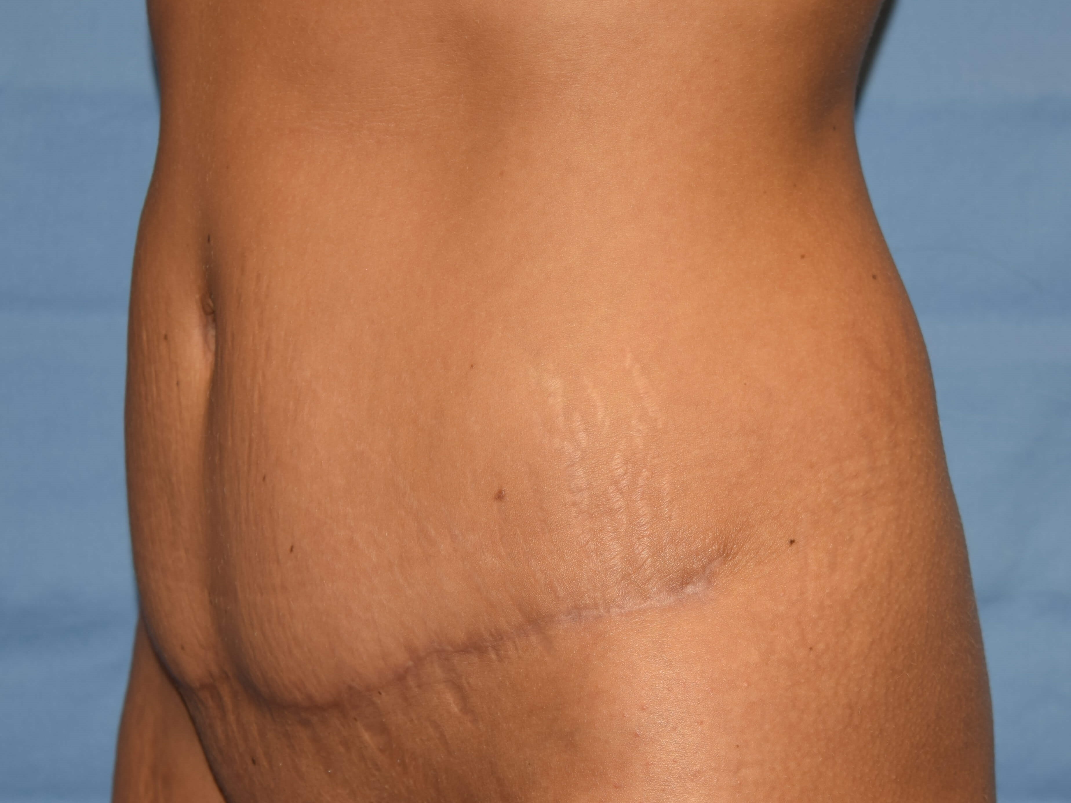 Oblique After
