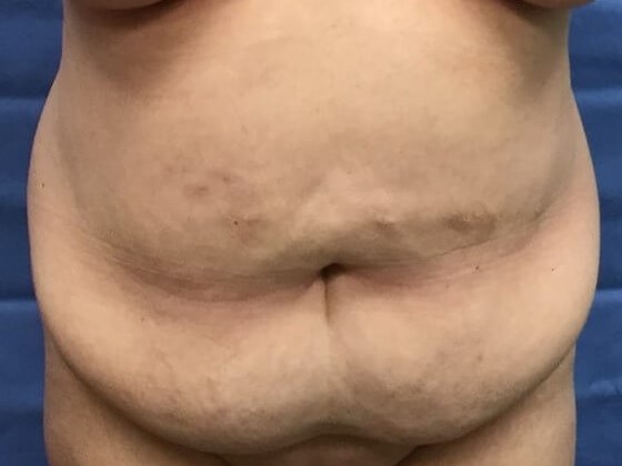 Anterior Before
