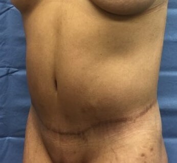 Oblique After