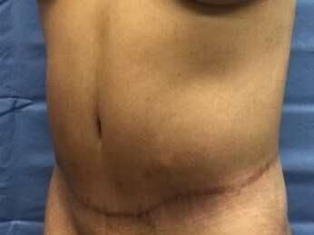 Oblique After