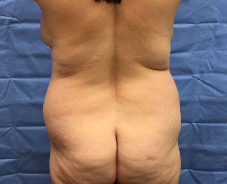 Posterior Before