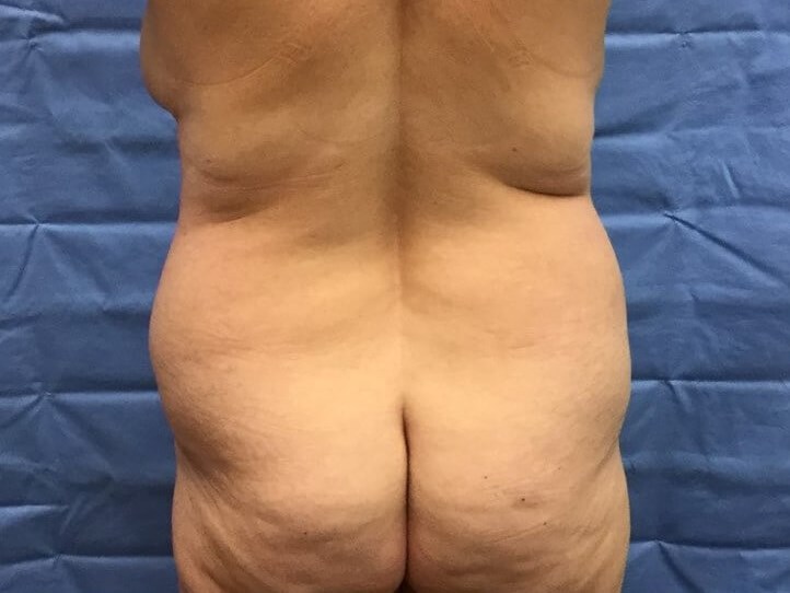 Posterior Before