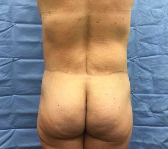 Posterior After