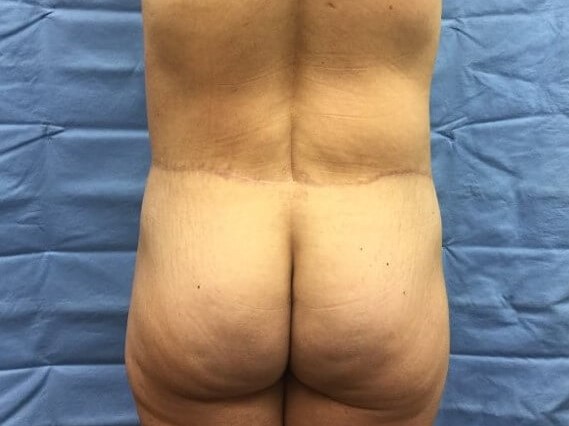 Posterior After