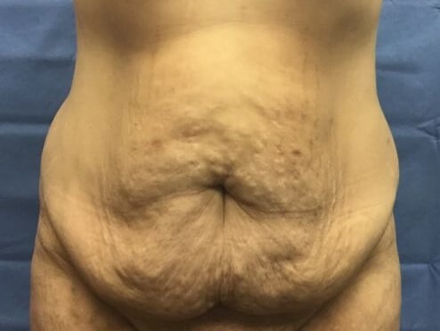 Anterior Before