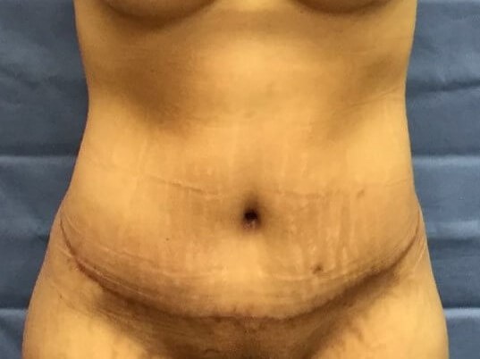 Anterior After
