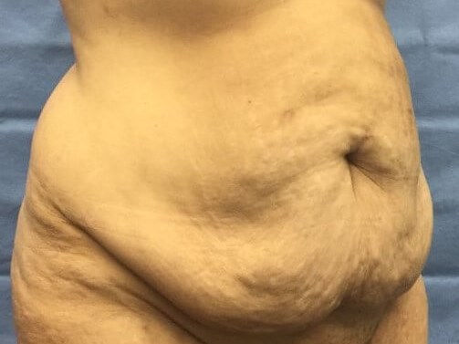 Oblique Before
