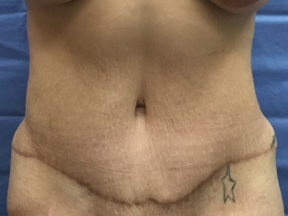 Anterior After