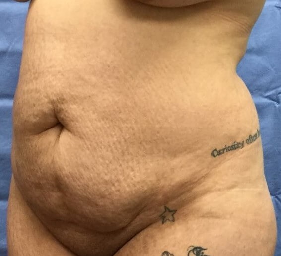 Oblique Before