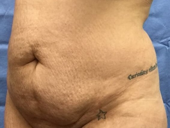 Oblique Before