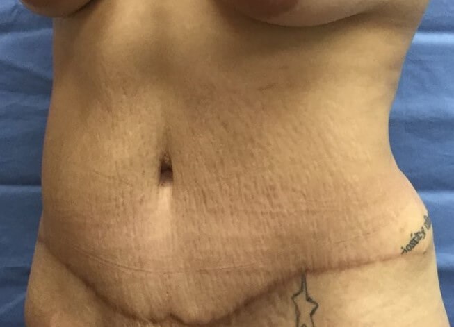 Oblique After