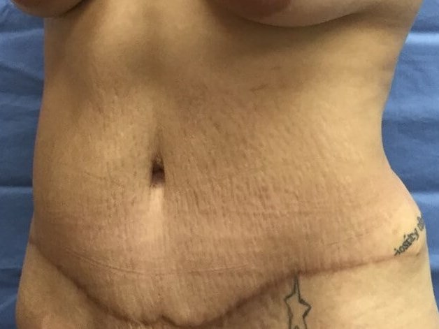 Oblique After