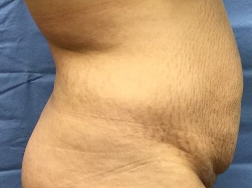 Side Before