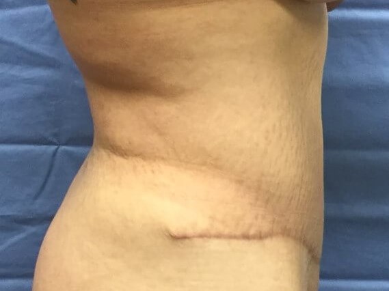 Side After