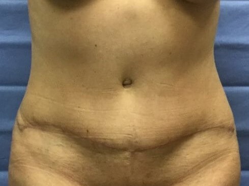 Anterior After