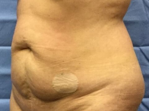 Oblique Before