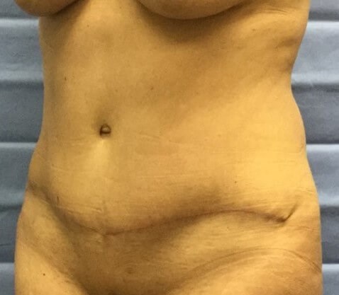 Oblique After