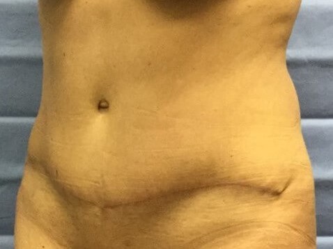 Oblique After