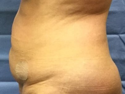 Side Before