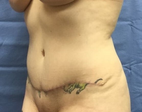 Oblique After