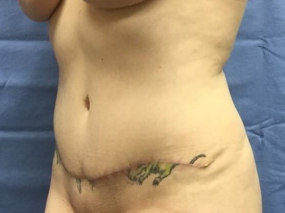 Oblique After