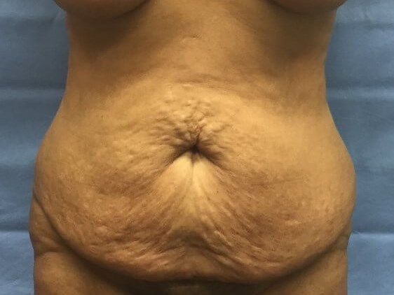 Anterior Before
