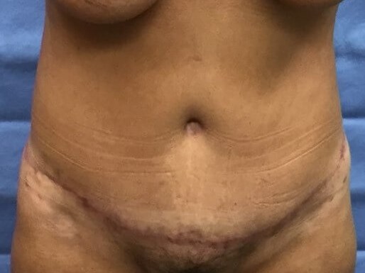 Anterior After