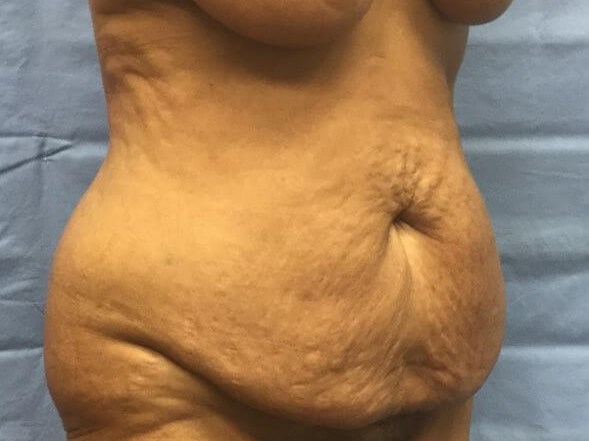 Oblique Before
