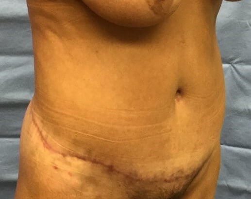 Oblique After